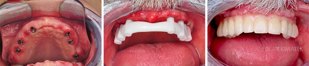 Prothetische Ergänzung bei völligem Zahnverlust - 6 Implantate, Multi-Unit-Verbindungen und 12 prothetische Kronen. Durchgeführt von der Klinik Kwiatek Poznań.