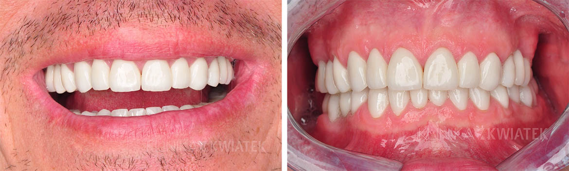 Zähne vor und nach der Nutzung der Dienste eines Prothetikers aus der Kwiatek Klinik in Posen.