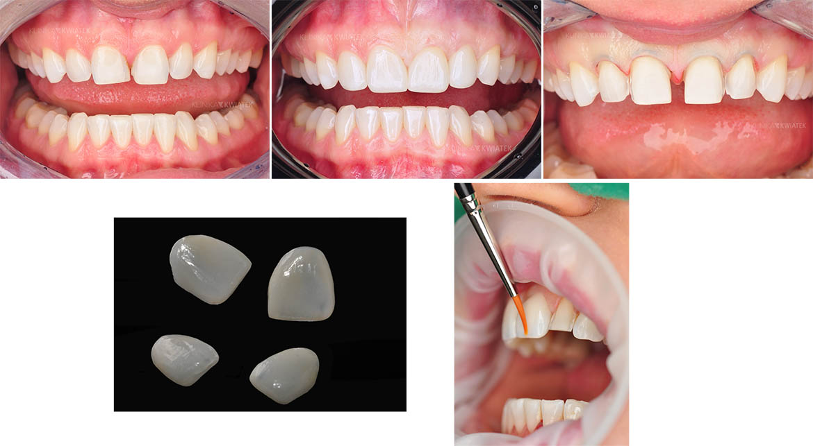 Veneers ermöglichen eine einfache Korrektur von Zahnfehlern.