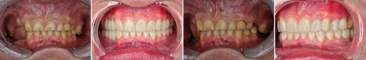 Patienten vor und nach der vollständigen Bissrekonstruktion zusammen mit der Verbesserung des Lächelns - Kwiatek Klinik Poznań