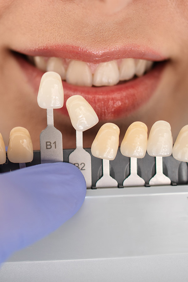 Kompositveneers, Porzellanveneers, Keramikveneers